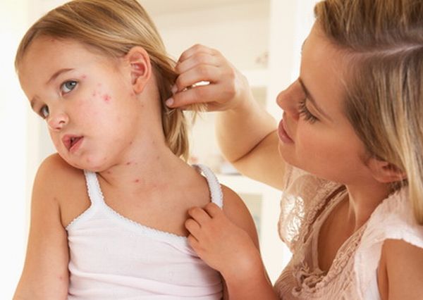 Epidemie de varicela în școlile și grădinițele din județul Mureș Epidemie de varicela în școlile și grădinițele din județul Mureș