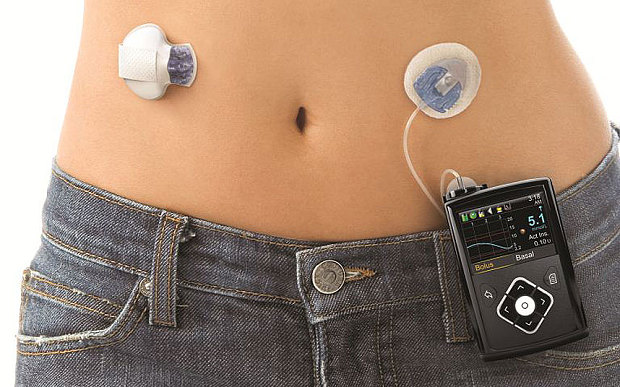 Pancreasul artificial ar putea fi disponibil în 2018