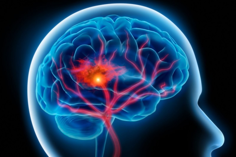 Accidentul vascular cerebral este principala cauză de dizabilitate din România