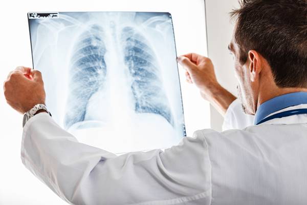 Un nou medicament destinat pacienţilor cu cancer pulmonar