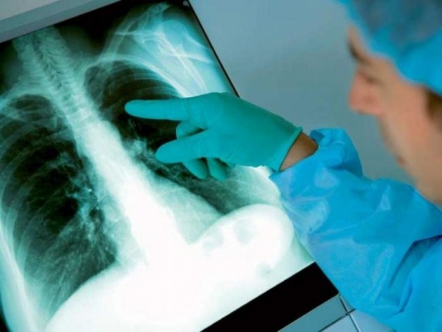 Azi este Ziua mondială de luptă împotriva tuberculozei