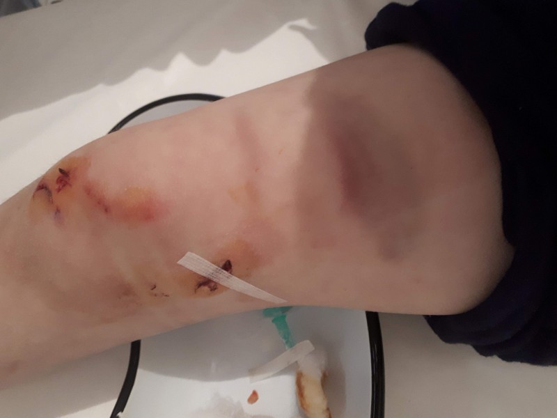 UPDATE Copil de 9 ani atacat de urs în Harghita