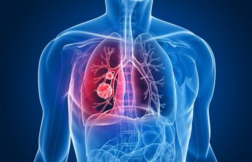 Explozie de cancere pulmonare după pandemie!