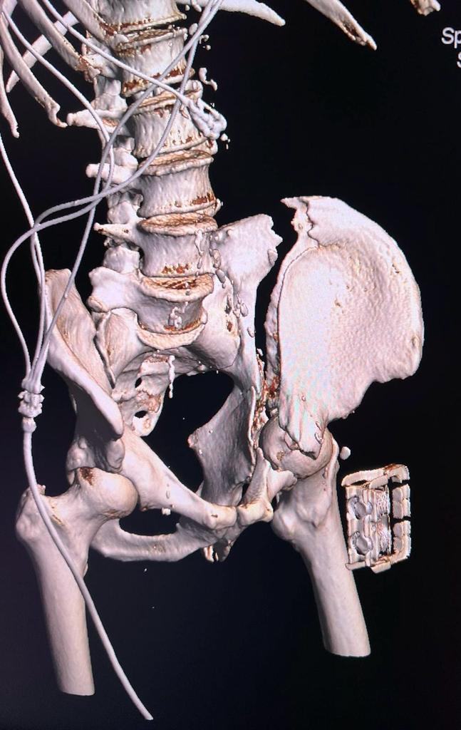 Prima intervenţie de fixare de bazin cu machetă 3D preoperator, la Spitalul Clinic Judeţean de Urgenţă Târgu Mureş