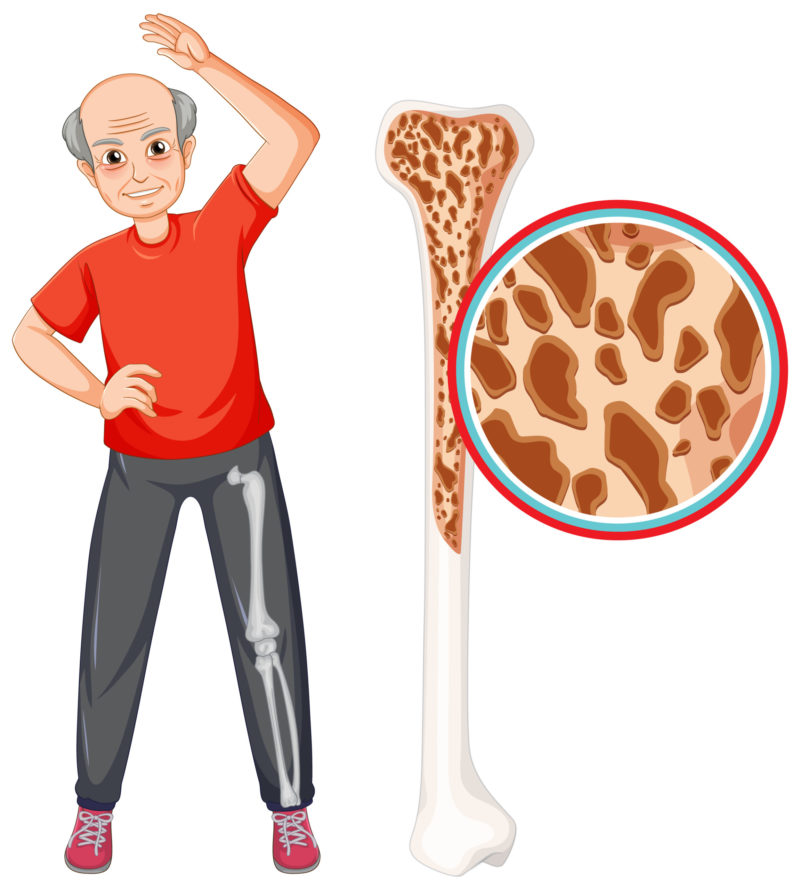 Ghid Medical | Riscul osteoporozei 