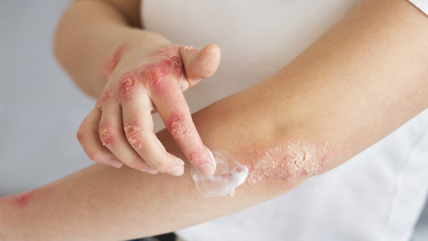 Ghid medical | Psoriazisul Ghid medical | Psoriazisul