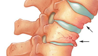 Ghid medical: Tratarea spondilozei cervicale