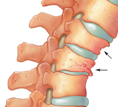 Ghid medical: Tratarea spondilozei cervicale