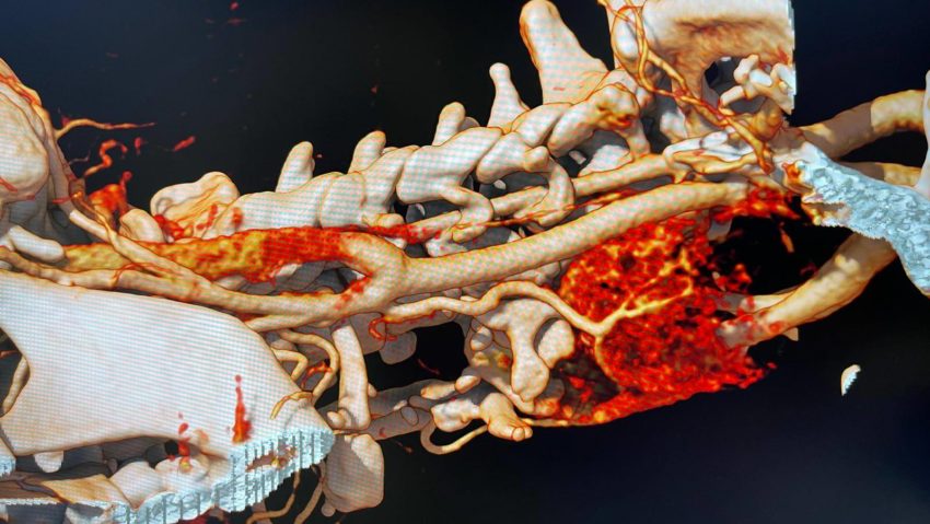 Minutul de Viitor, cu Raluca Creț | Prima embolizare arterială tiroidiană din România, la Spitalul Universitar de Urgență București Minutul de Viitor, cu Raluca Creț | Prima embolizare arterială tiroidiană din România, la Spitalul Universitar de Urgență București